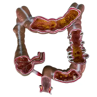 Intestino Grosso Humano com Patologia, Anatomia