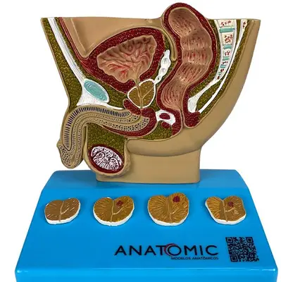 Modelo de Próstata, com Patologias