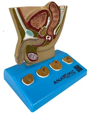Modelo de Próstata, com Patologias